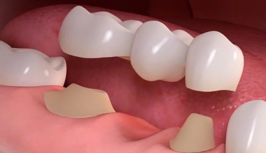 تركيبات الأسنان
